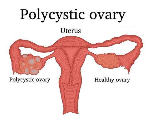 Pcos Ovary Pain