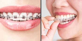 Invisalign vs. Braces