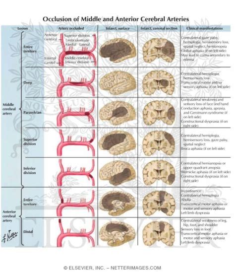 Occlusion of Middle and Anterior Cerebral Arteries