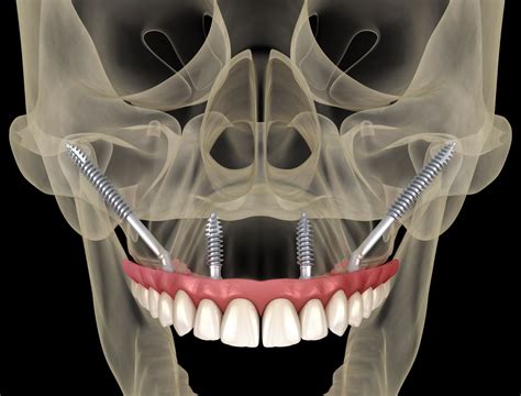 Implants zygomatiques : Définition et Avantages | Clinique Evoro