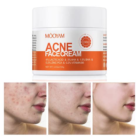 Buy Acne Treatment for Face, Salicylic Acid Acne Cream Back Acne Treatment Cream for Teens ...