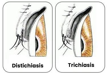 Eyelash Diseases - Prof. Dr. Tamer DEMİR