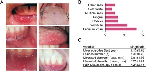 Clinical manifestations of recurrent aphthous stomatitis. (A)... | Download Scientific Diagram