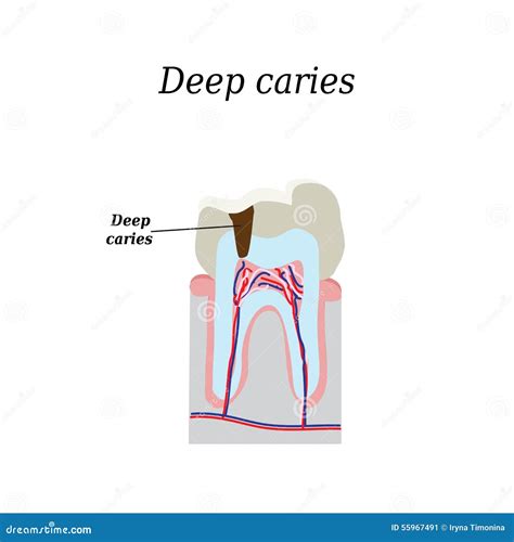 Decay And Abscess Cross-section Structure Inside Tooth Vector ...