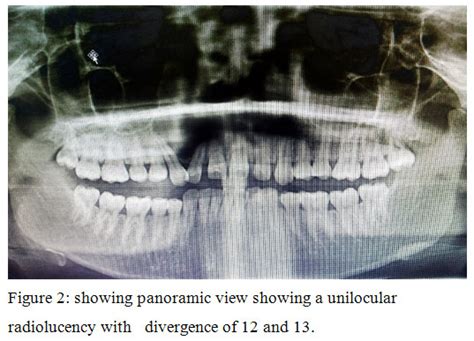 Lateral Periodontal Cyst_A Case Report | Biomedical and Pharmacology ...