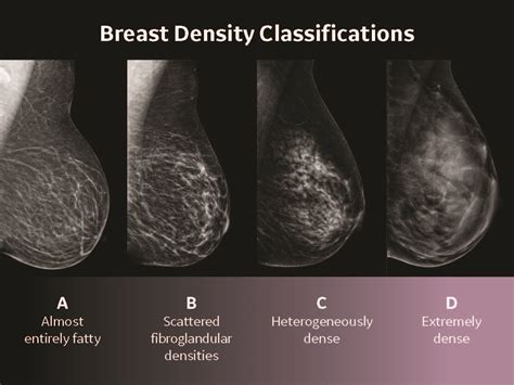 Automated Breast Ultrasound (ABUS) | Florence, AL