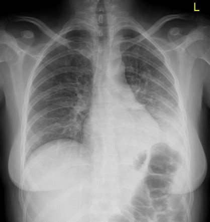 Lobar Pneumonia