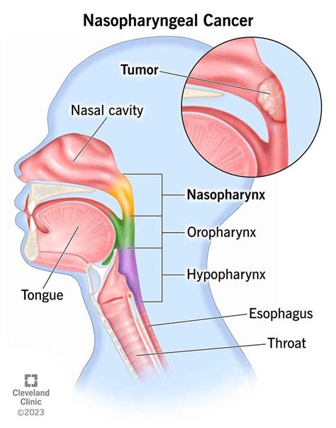 Nasopharyngeal Cancer: Symptoms, Causes Treatment, 42% OFF