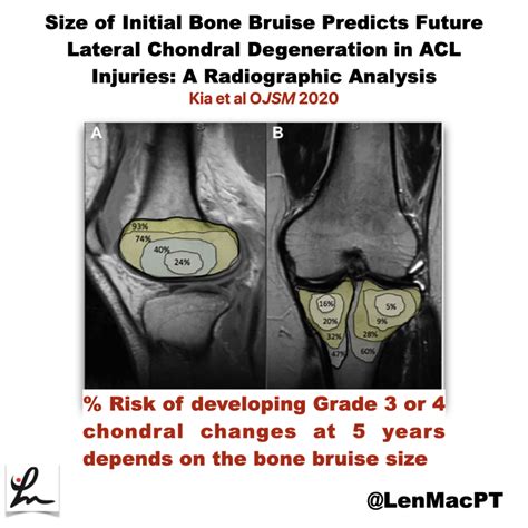 ACL tears and bone bruises - Lenny Macrina