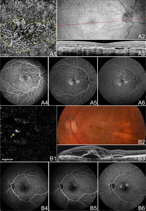 A review of optical coherence tomography angiography (OCTA ...