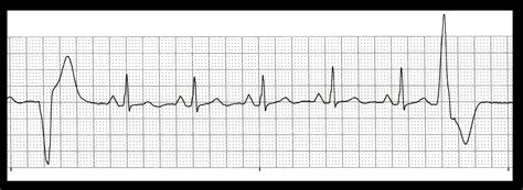 Float Nurse: Practice EKG Strips 317