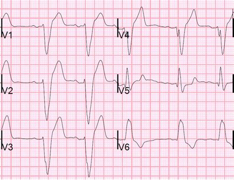 Dr. Smith's ECG Blog: New LBBB after Cardiac Arrest