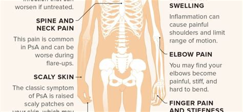 Psoriatic arthritis – Symptoms and Treatment – Healthy Food Near Me