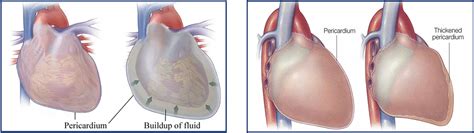 Pericardial Diseases | Dr Krasopoulos