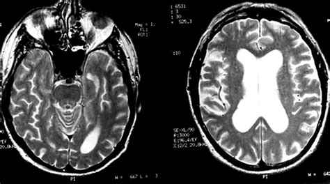 Hsv Encephalitis Mri - Radiology MRI: Herpes Simplex Encephalitis : Encephalitis in the ...