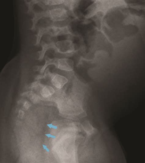 Sacrococcygeal Teratoma • APPLIED RADIOLOGY