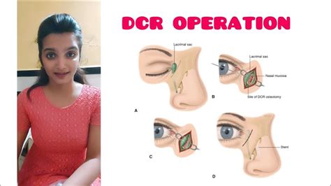 Dacryocystorhinostomy (DCR)surgery /Dacryocystitis -Part 2 -A K Khurana - YouTube