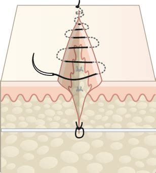 10 Wound closure and coverage techniques (I) | Musculoskeletal Key