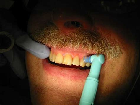 Tooth polishing - Wikiwand