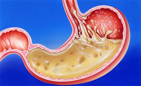 5 Signs You May Have Low Stomach Acid - Austin Texas Functional ...