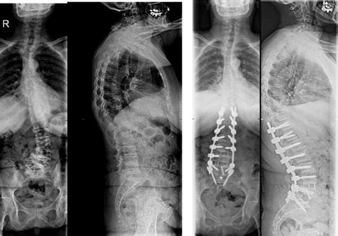 Lumbar Lordosis Correction With Interbody Hyperlordotic Cages: Initial Experience, Learning ...