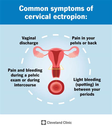 Cervical Ectropion: Causes, Symptoms & Treatment