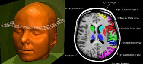 Transverse MRI Cross-Sections