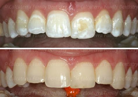 Fixing White Spots after Braces with Bonding | Orange, CT