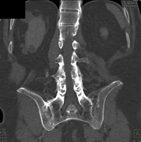 Ankylosing Spondylitis CT Scan