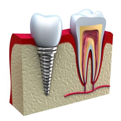 IMPLANTS - Aspen Oral and Facial Surgery