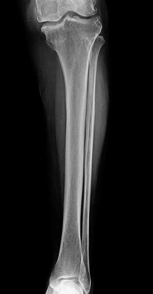 Lower Leg Xray Xray Image Of Leg Front View Xray Of Normal Leg Bone In ...