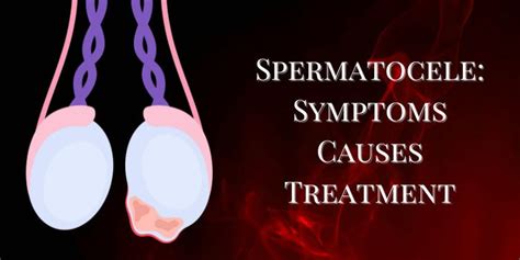 Spermatocele: Symptoms, Causes and Treatment - Liv Muztang