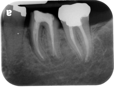 Case of the Week: Vertical root fracture – Dr. G's Toothpix