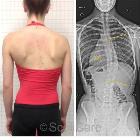 Case Study - Thoracic Scoliosis Treatment For Ballerina