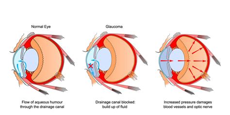 Glaucoma in Cats: Causes, Symptoms & Treatment - Cat-World