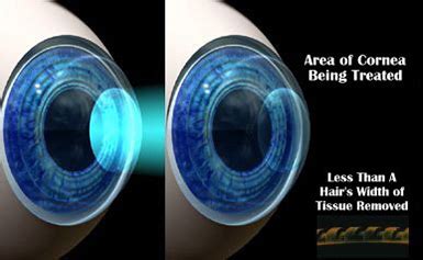 Laser Vision Correction, Minneapolis, Minnesota