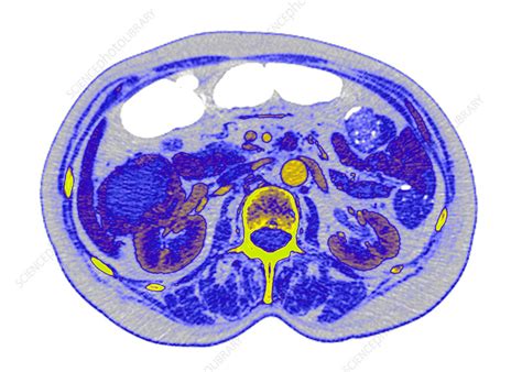 Kidney cancer, CT scan - Stock Image - C026/7599 - Science Photo Library