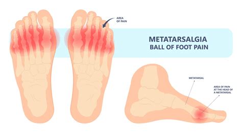 Metatarsal Pain