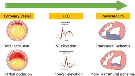 Total coronary occlusion in non ST elevation myocardial infarction: Time to change our practice ...