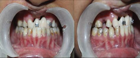 Treatment of severe maxillary cleft hypoplasia in a case with missing premaxilla with anterior ...