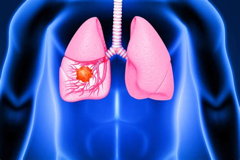 Choosing Between Lung Cancer Surgery and Radiation | Cancer Today