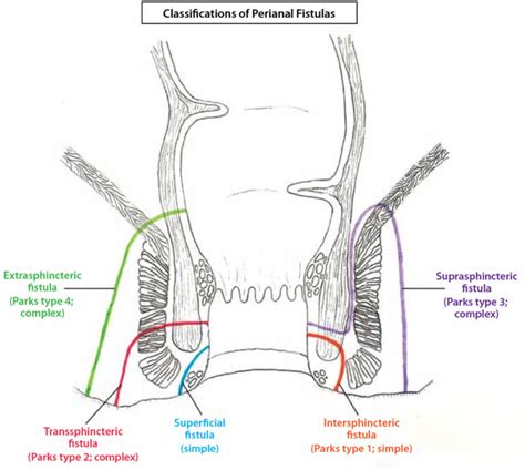 Perianal fistula causes, symptoms, diagnosis, treatment & surgery