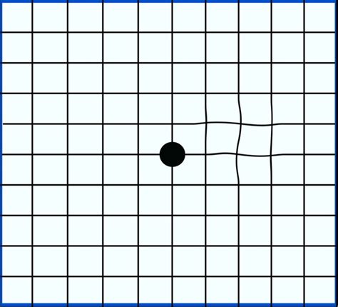 An Amsler grid showing mild distortion. | Vision News and Research ...