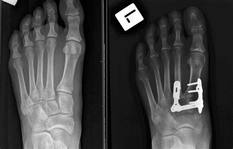 Lisfranc injury: A runners worst nightmare: The Lisfranc injury: Symptoms, Diagnosis, and ...