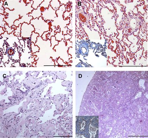 Interstitial Lung Disease Histology