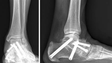 Mid- to long-term outcome of 96 corrective hindfoot fusions in 84 ...