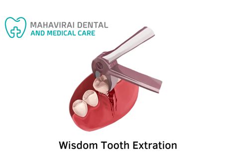 Wisdom Tooth Extraction in Gurgaon - Mahavirai Dental and Medical Care - Best Dental Clinic in ...