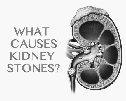 Causes of Kidney Stone(Nephrolithiasis) - PT Master Guide