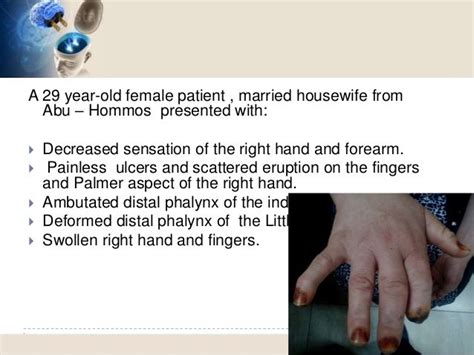 Syringomyelia ( Morvan syndrome) Electrodiagnosis