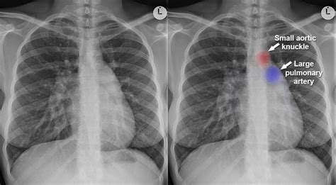 Can A Chest X-Ray Detect Congestive Heart Failure?